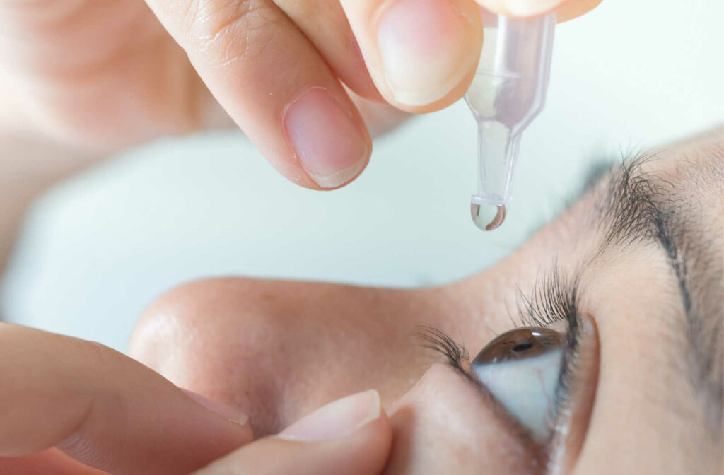 A close up of a person putting eye drops in their eyes to relieve the uncomfortable symptoms of dry eye