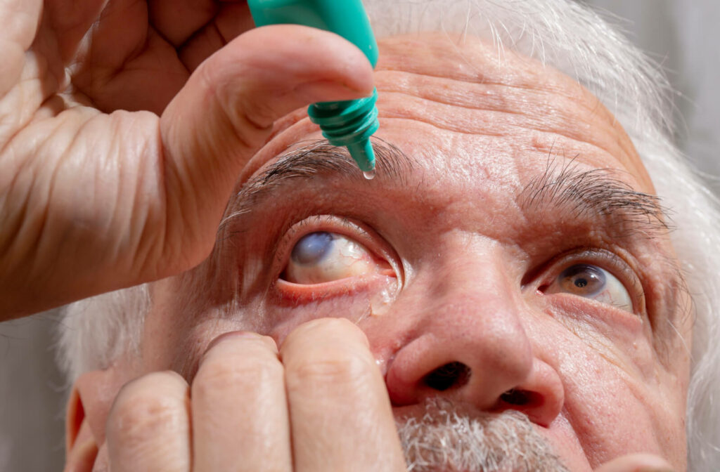 A senior man with glaucoma pulling down his lower eyelid to put eye drops in his eye.