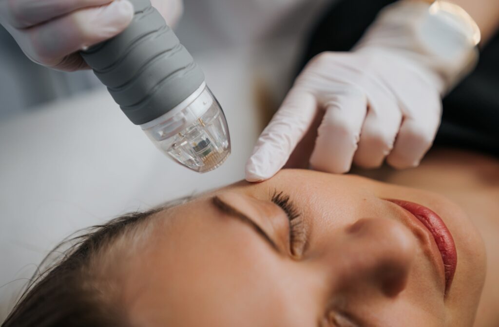 A closeup of a young woman undergoing dry eye therapy with radiofrequency treatments.