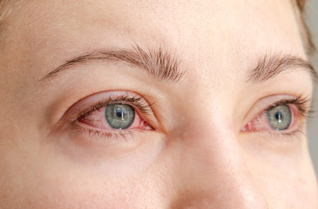 A closeup of a person's eyes. Both eyes are swollen and red due to an allergic reaction.