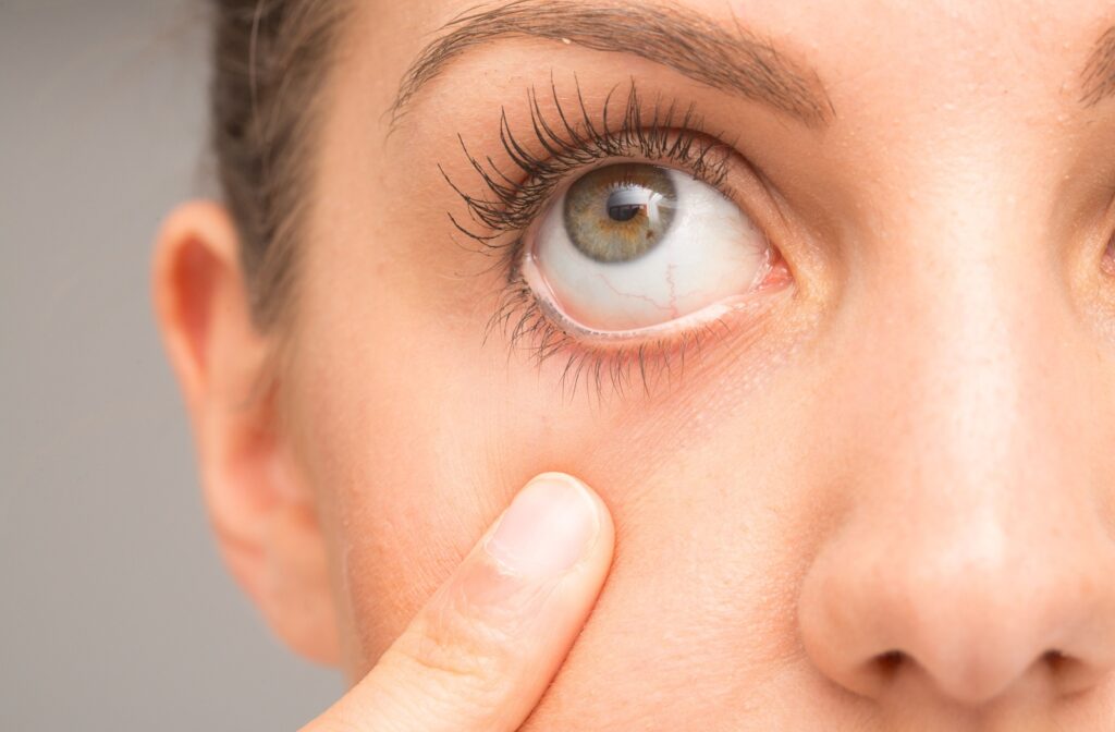 A woman pulls down on her face, exposing the sclera of her eye.