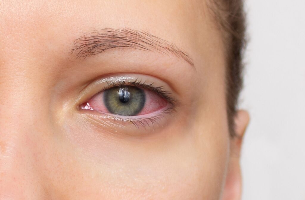Close-up image of an eye with visible redness, illustrating symptoms of dry eye and light sensitivity.
