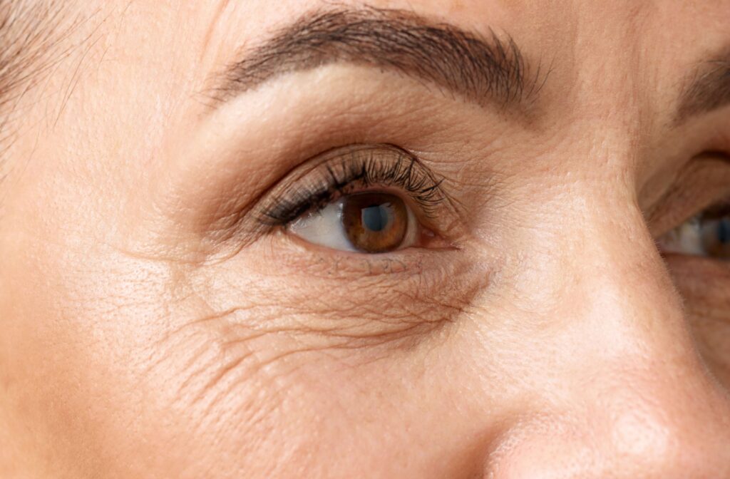 Close-up image showing fine lines and wrinkles around the under-eye area, illustrating the natural aging process.