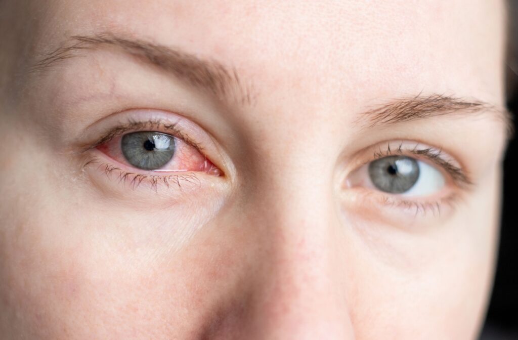A close up of a person with a red eye caused by having dry eyes