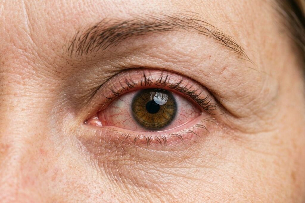 Close-up of an adult's open eye with a hazel iris, the white part of the eye visibly red and irritated.